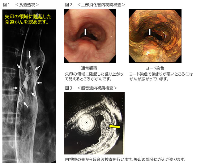 食道がんの診断