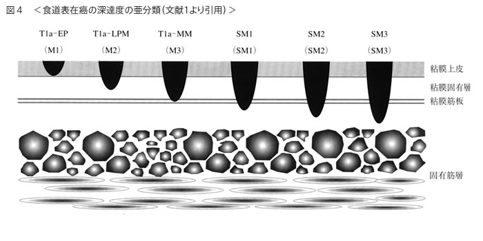 食道がんの診断