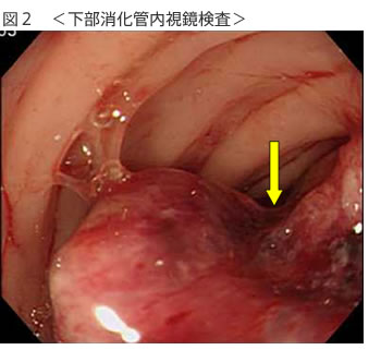 大腸がんの診断