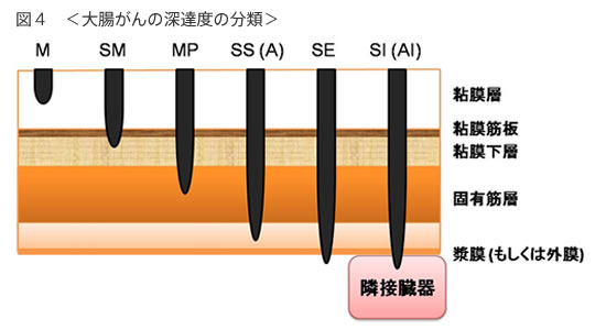 大腸がんの診断