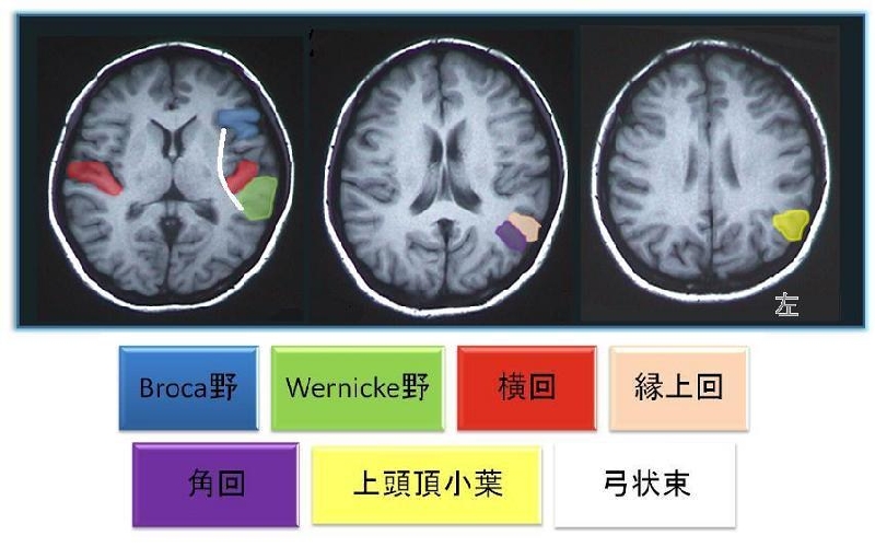 失語症に関連する部位