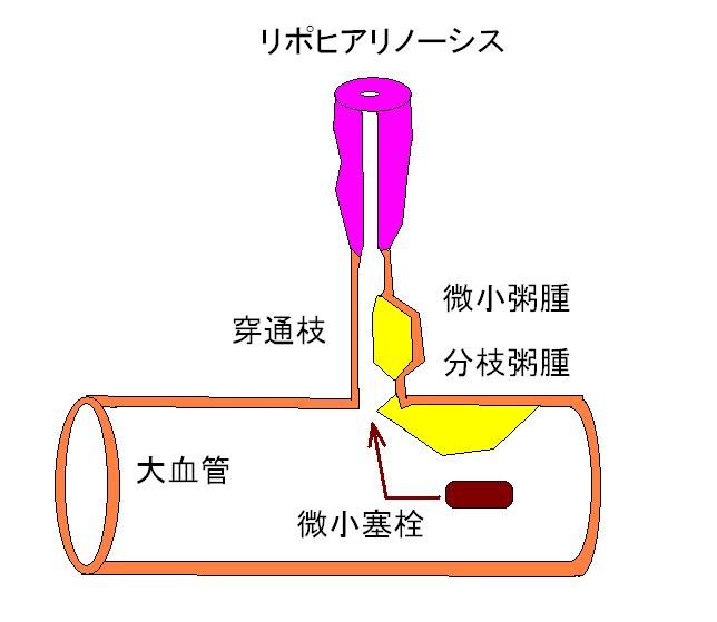 ラクナ梗塞