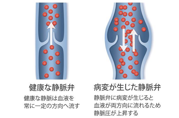 下肢静脈瘤