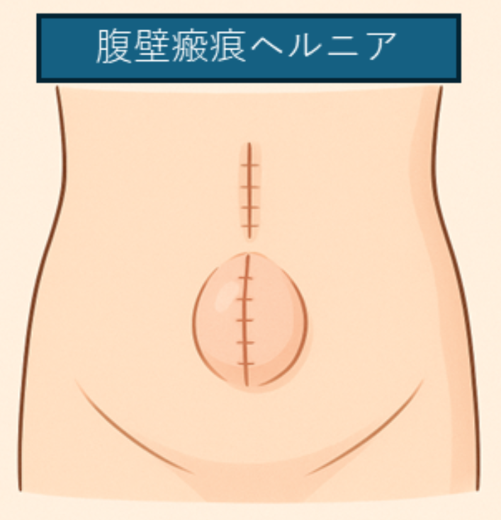 腹壁ヘルニアの説明図