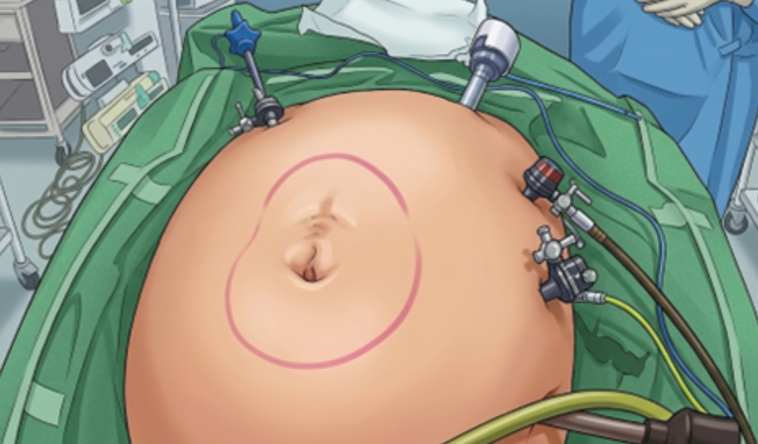 eTEP手術のイメージ